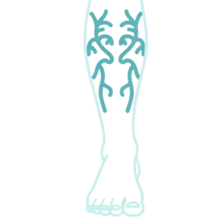 Варикозное расширение вен нижних конечностей