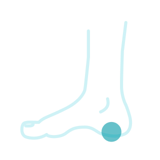 Плантарный фасциит