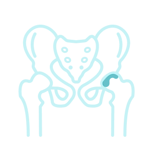 Коксартроз